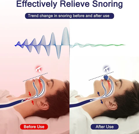 RYNX | Micro Cpap Sleep Apnea Machine For Travel & Anti-Snoring - Cpap Alternative