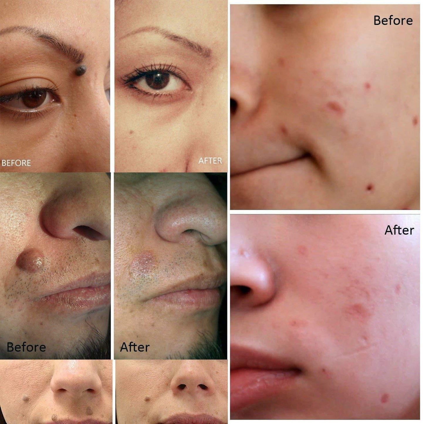 RYNX | Tag Remover Pen, Mole And Wart Removal