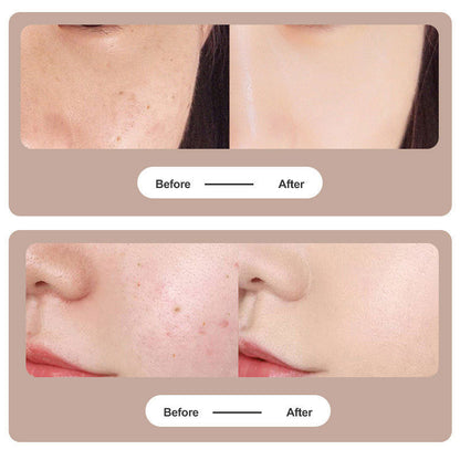 RYNX | Plasma Pen Laser For Tattoo And Mole Removal
