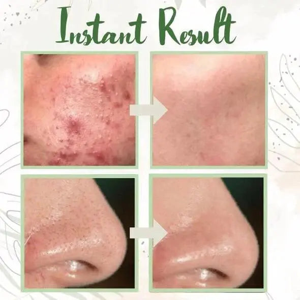 Rynx | Green Tea Deep Cleansing Mask – Against Sebum, Dirt & Clogged Pores