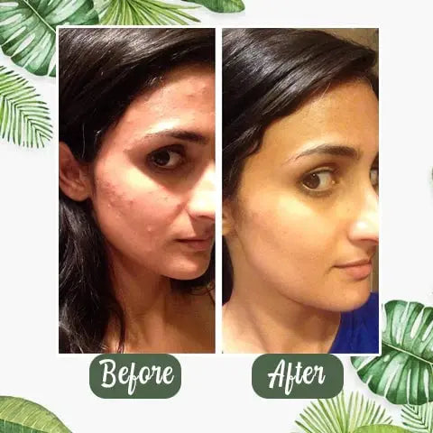 Rynx | Green Tea Deep Cleansing Mask – Against Sebum, Dirt & Clogged Pores