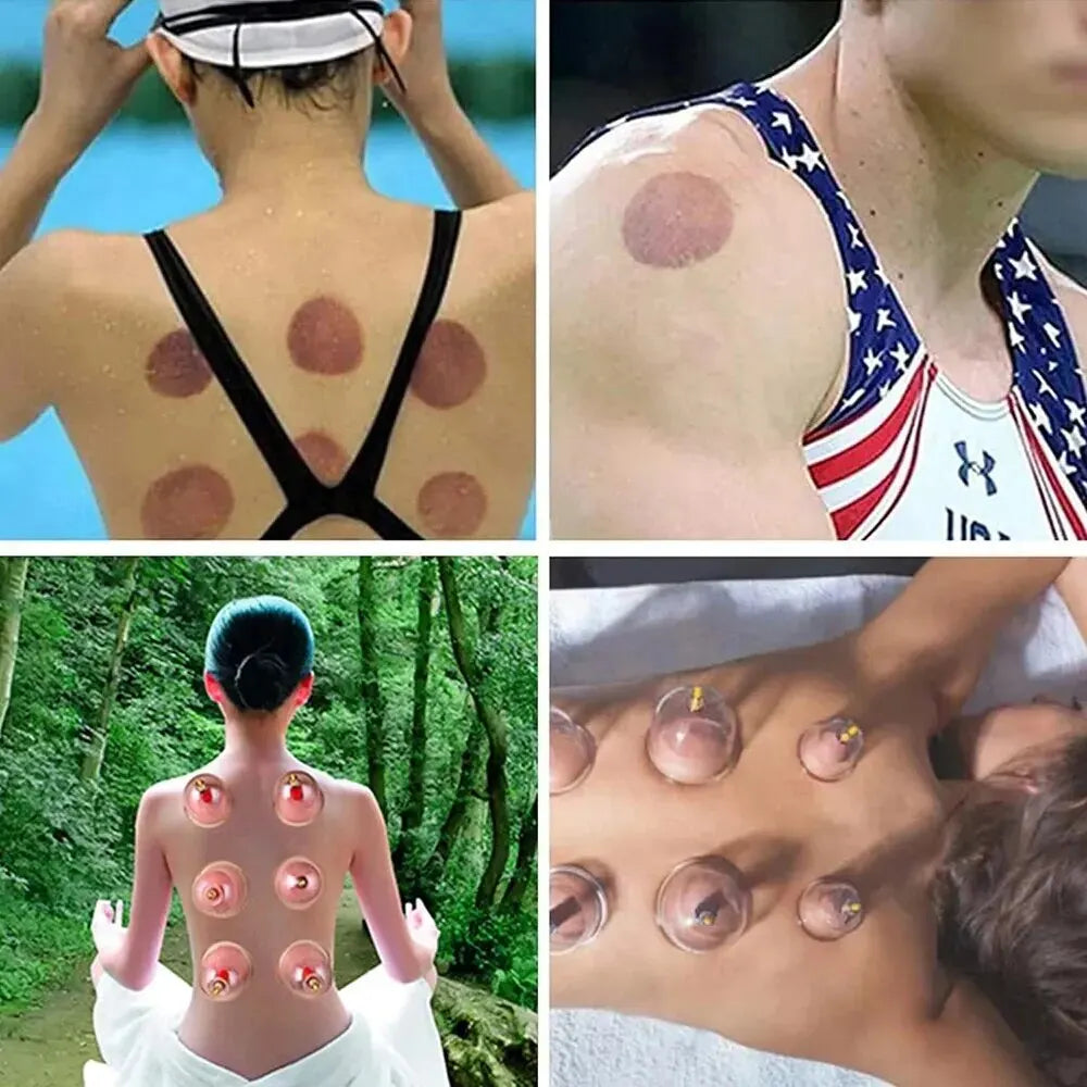 Rynx | 32-Glass Vacuum Cupping Set: Extensive Body Massage Care For Shoulders And More