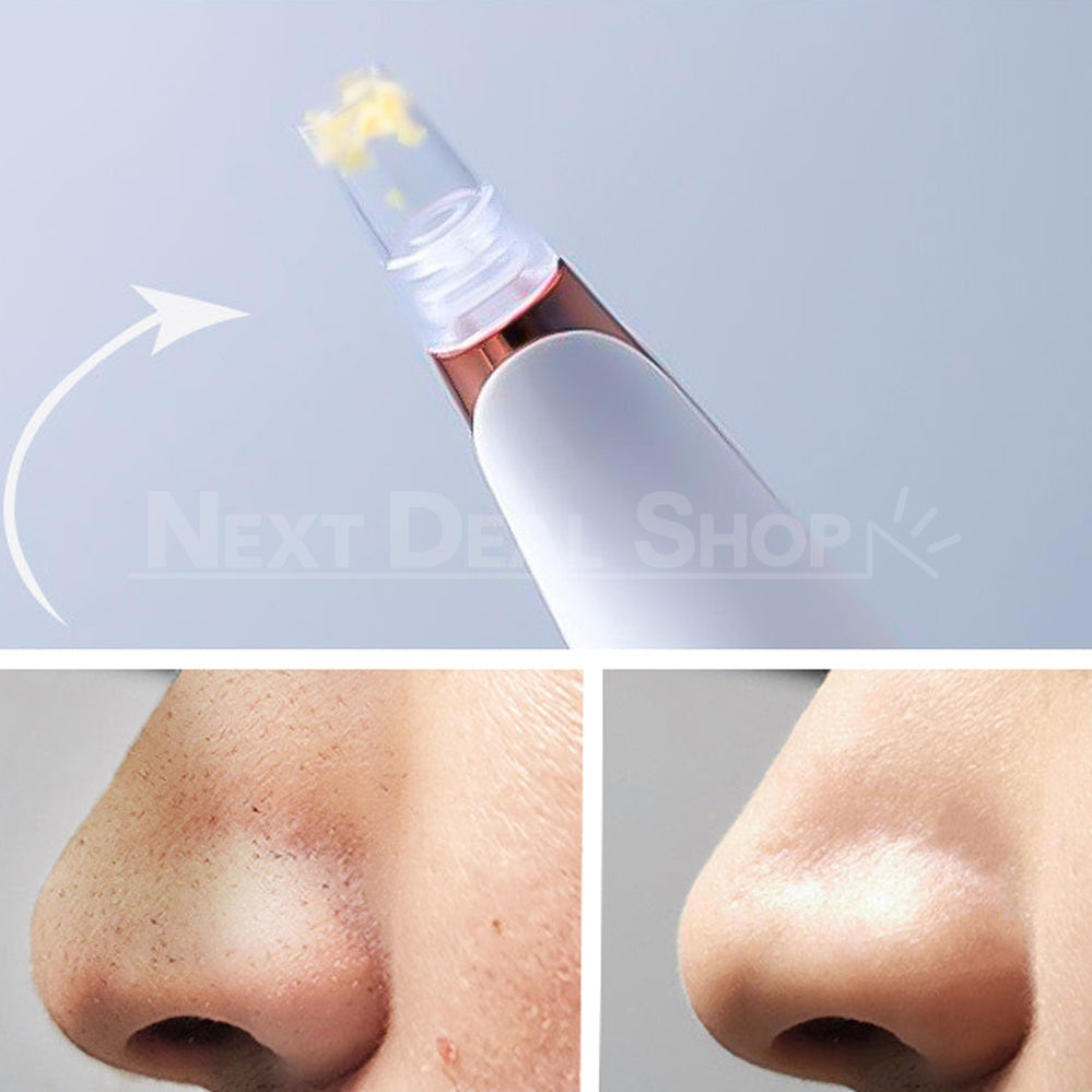 Rynx | Electric Blackhead Remover Pore Vacuum