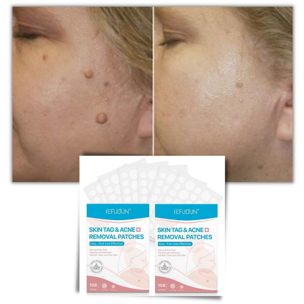 RYNX | Skin Patch - Remove Moles And Warts In A Natural Way!