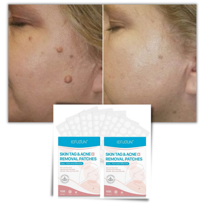 RYNX | Skin Patch - Remove Moles And Warts In A Natural Way!