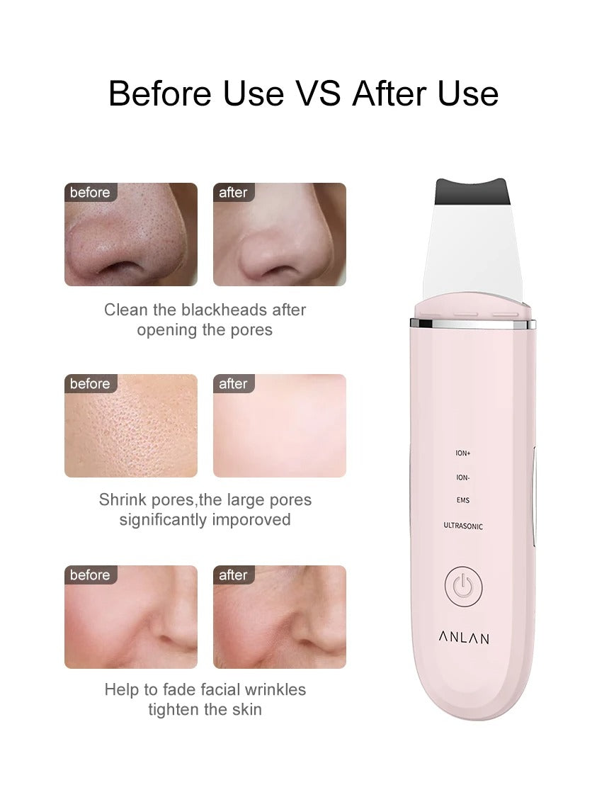 Rynx | Ultrasonic Skin Scrubber | Deep Cleansing Facial Peeling Spatula | Pore and Blackhead Removal Tool