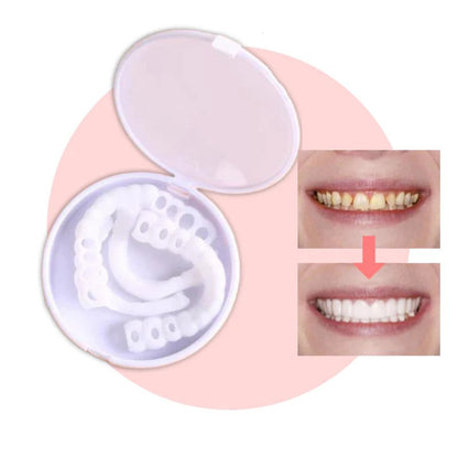 RYNX | Smilesnap - Always The Perfect Smile With These Veneers Upper and lower teeth