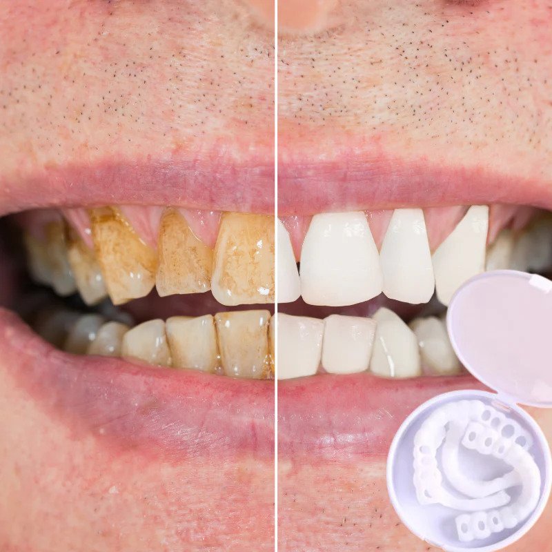RYNX | Smilesnap - Always The Perfect Smile With These Veneers