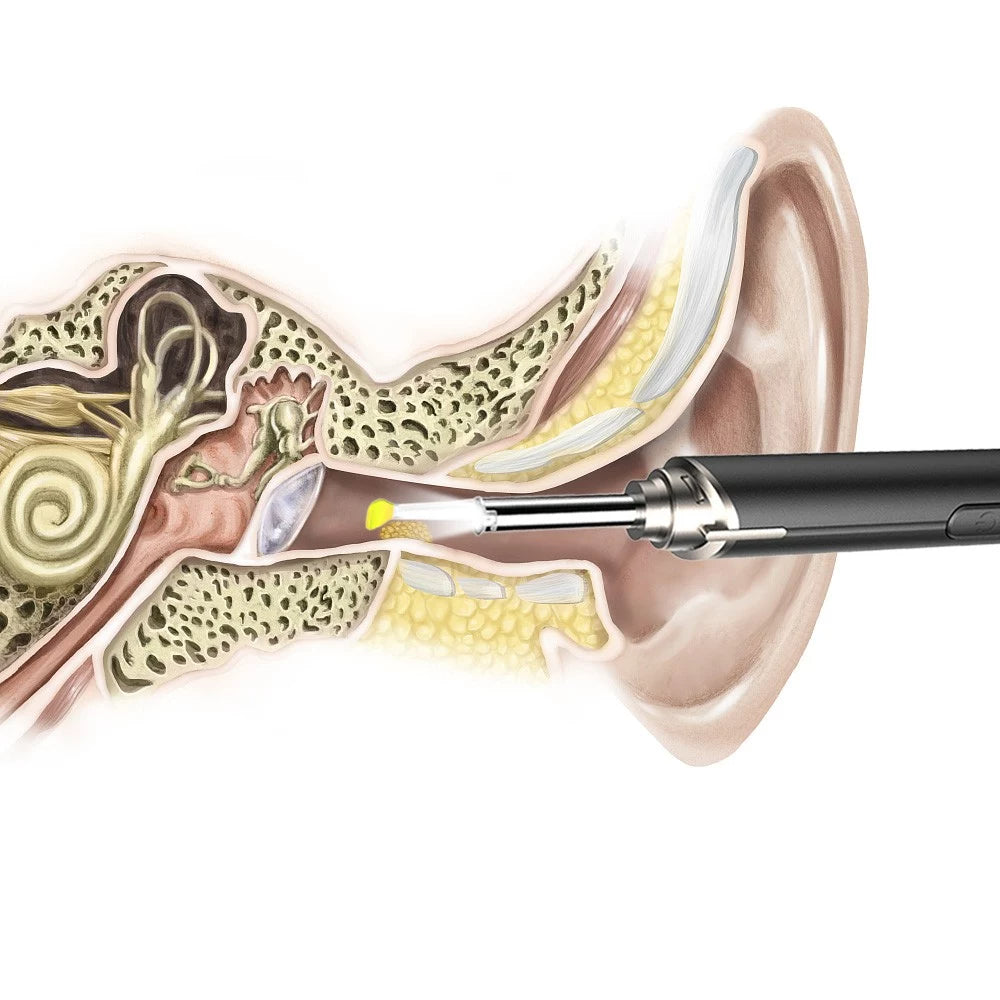 Rynx | Intelligent Visual Ear Otoscope Inspection Tool