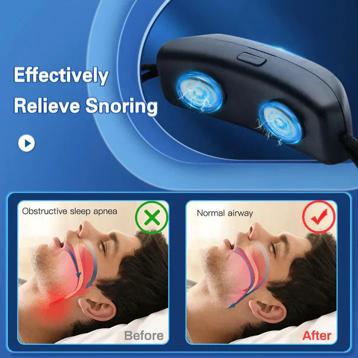 RYNX | EMS Anti-Snoring Device – Portable, Comfortable Sleep Aid, USB Rechargeable